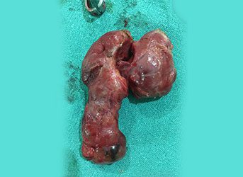 Removes-Thyroid-with....-343x250