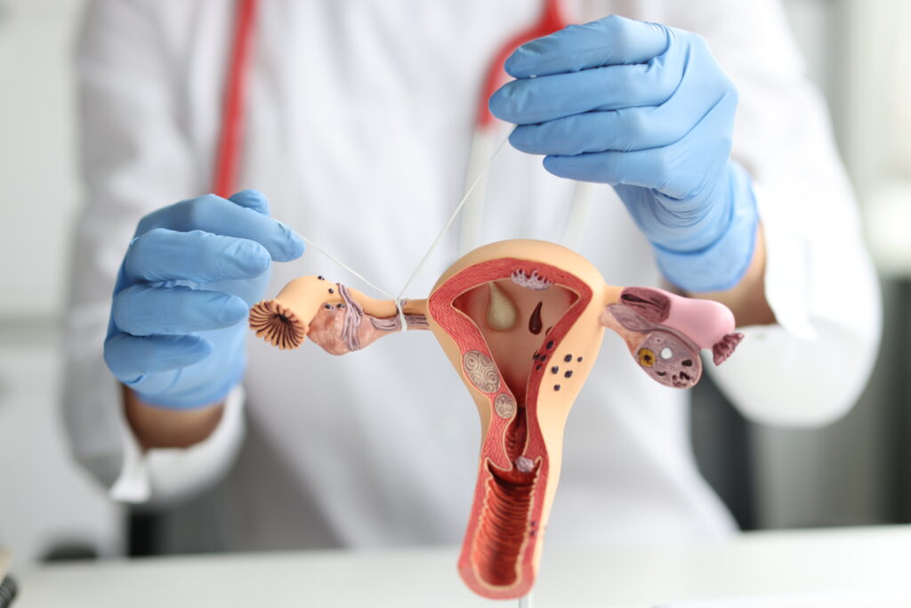 Myomectomy laparoscopy