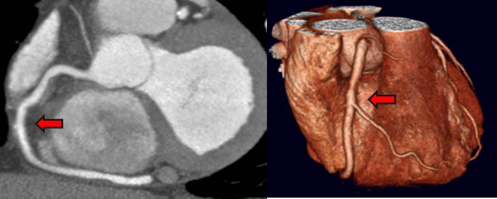 CT Coronary Angiogram to Defeat ‘block in the heart’