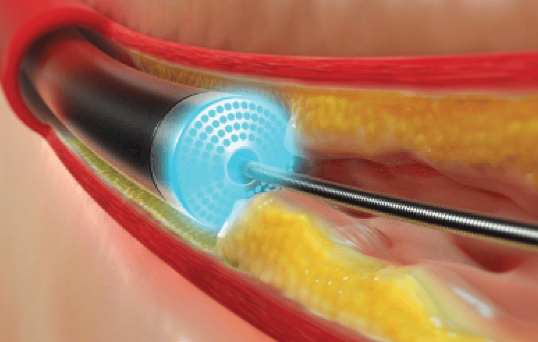 Laser Angioplasty for Chest Pain