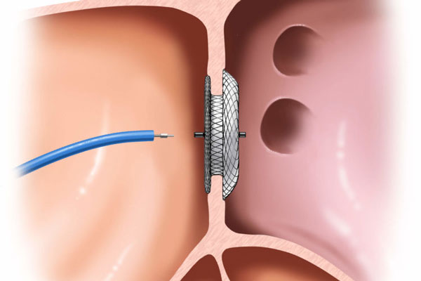 Devise Closure for ‘Hole in the Heart’