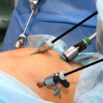 Total Laparoscopic Hysterectomy