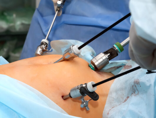 Total Laparoscopic Hysterectomy