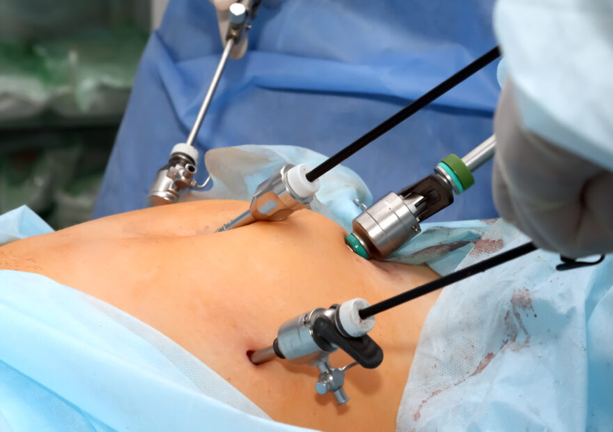 Total Laparoscopic Hysterectomy