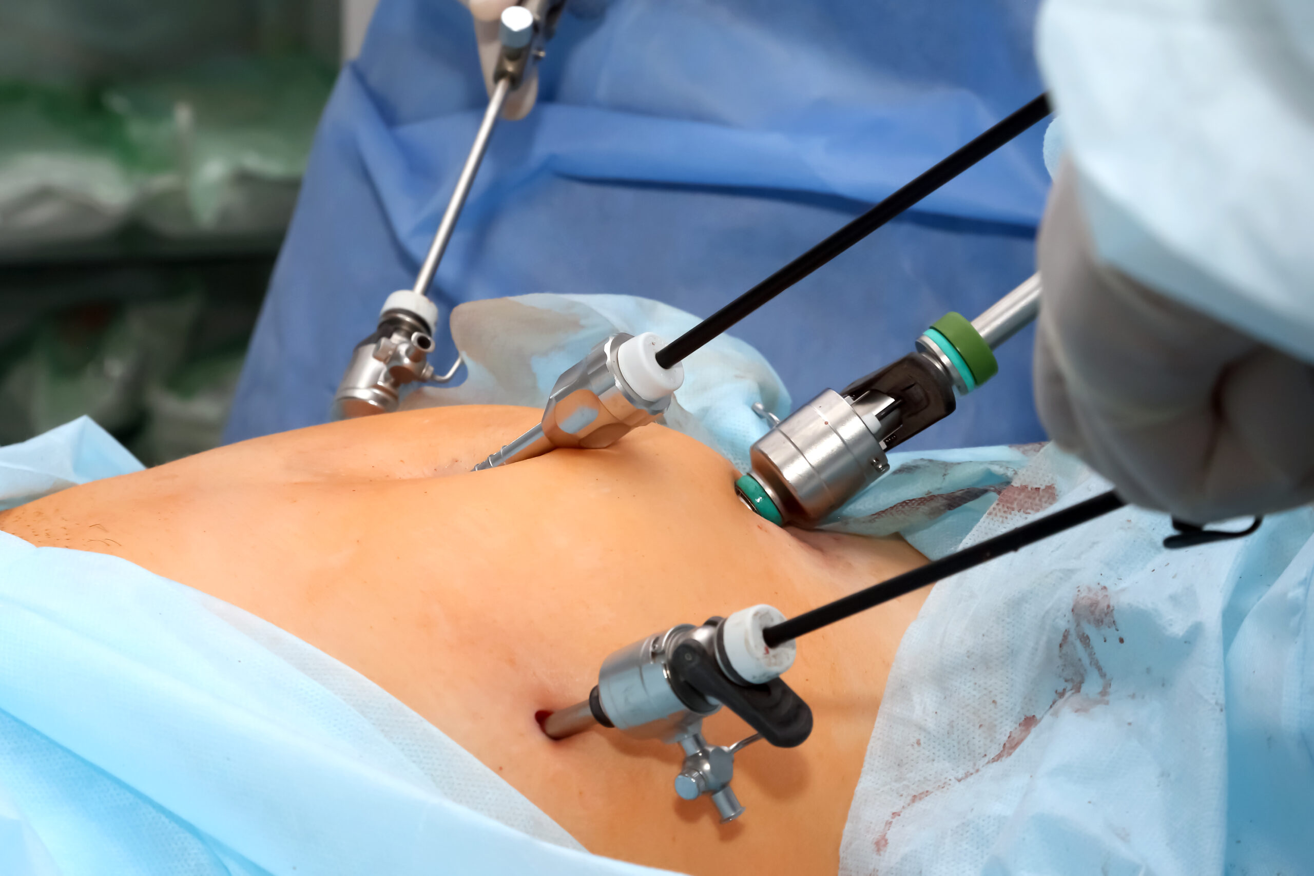 Total Laparoscopic Hysterectomy