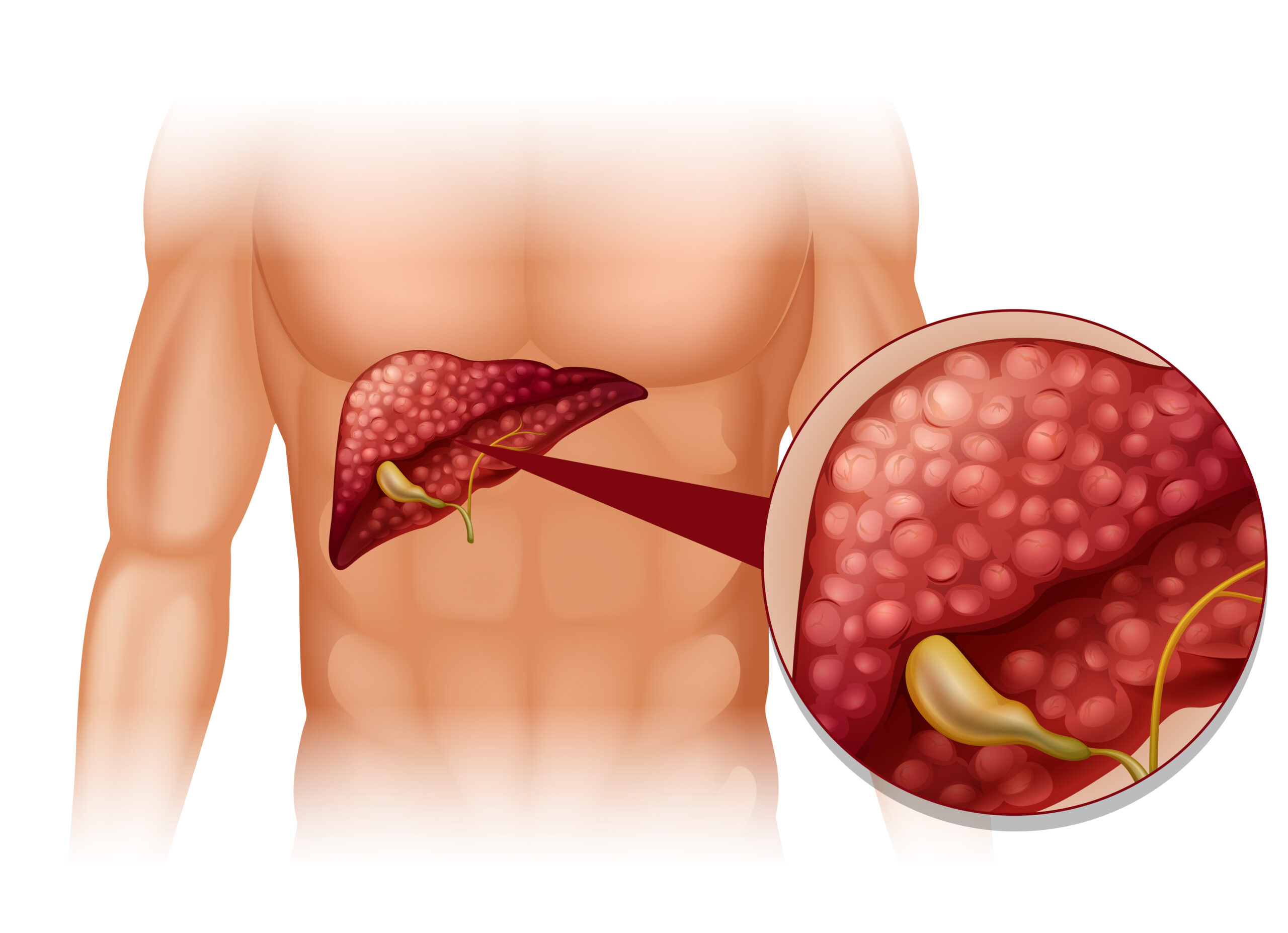Best Fatty Liver treatment hospital in kerala